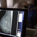 Câncer de mama: uma em cada três pacientes tem menos de 50 anos